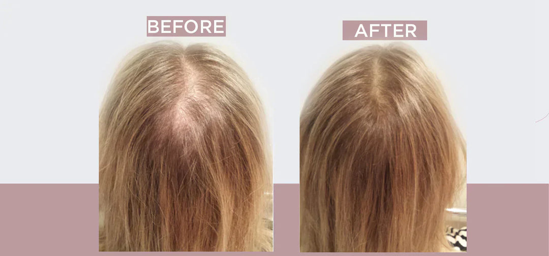 6 Ways to Hide Hair Loss and Thinning Hair in a Female
